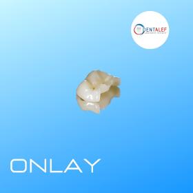 onlay